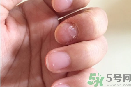 孩子手指甲凹凸不平是什么原因？手指甲凹凸不平的原因是什么？