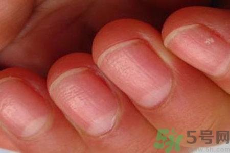 手指甲凹凸不平是怎么回事？如何預(yù)防手指甲凹凸不平？