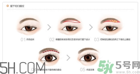 切眉手術后老得快嗎？切眉能保持多久？