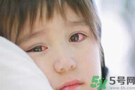 流行性腮腺炎的表現(xiàn)有哪些？?流行性腮腺炎飲食怎么調(diào)理？