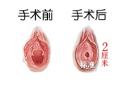 處女膜修補(bǔ)術(shù)效果怎么樣？處女膜修復(fù)手術(shù)有風(fēng)險嗎？