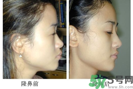 玻尿酸隆鼻的危害有哪些？玻尿酸隆鼻的副作用是什么？