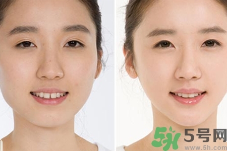 玻尿酸隆鼻的危害有哪些？玻尿酸隆鼻的副作用是什么？