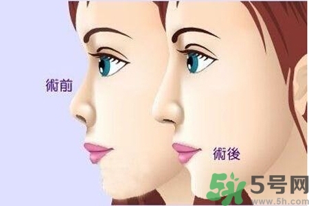 玻尿酸隆鼻的缺點是什么？玻尿酸隆鼻的優(yōu)點有哪些？