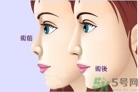玻尿酸隆鼻和手術(shù)隆鼻的區(qū)別是什么？