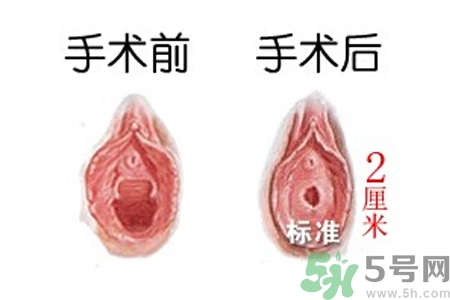 處女膜修補術效果怎么樣？處女膜修復手術有風險嗎？