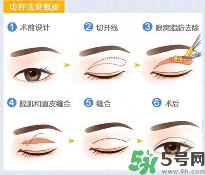 雙眼皮手術(shù)哪種最好？割雙眼皮后注意些什么？