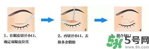 雙眼皮手術(shù)哪種最好？割雙眼皮后注意些什么？
