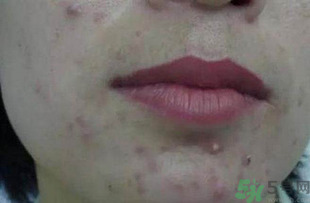 什么樣的痘痘能擠？哪些痘痘不能擠？
