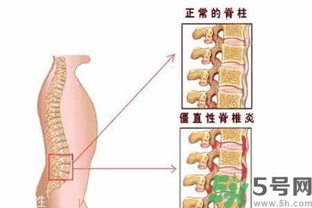 僵直性脊椎炎的癥狀有哪些？怎樣預(yù)防僵直性脊椎炎？