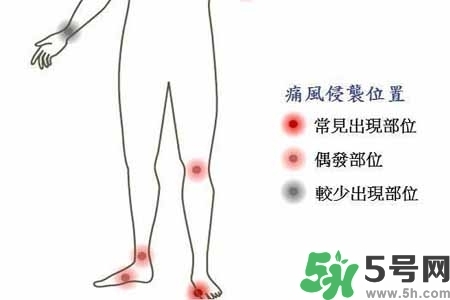 引發(fā)痛風(fēng)的原因是什么？痛風(fēng)病人飲食需注意什么好？