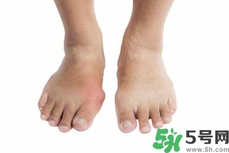 引發(fā)痛風(fēng)的原因是什么？痛風(fēng)病人飲食需注意什么好？