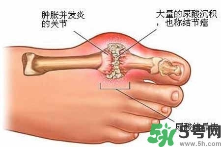 引發(fā)痛風(fēng)的原因是什么？痛風(fēng)病人飲食需注意什么好？