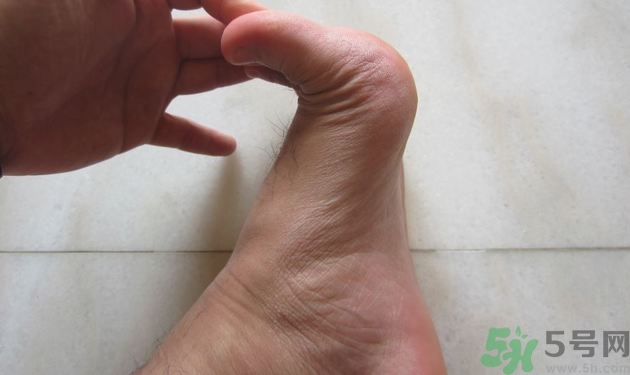 腳拇指外翻遺傳嗎？腳拇指外翻怎么矯正？