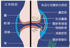 骨關(guān)節(jié)炎能治好嗎？骨關(guān)節(jié)炎平時注意事項