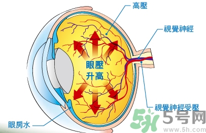 青光眼可以治愈嗎？青光眼怎樣治療？