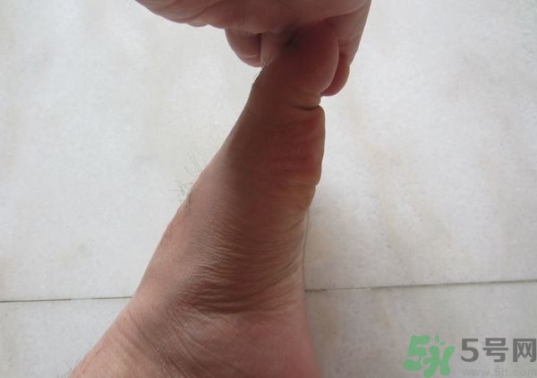 腳拇指外翻遺傳嗎？腳拇指外翻怎么矯正？