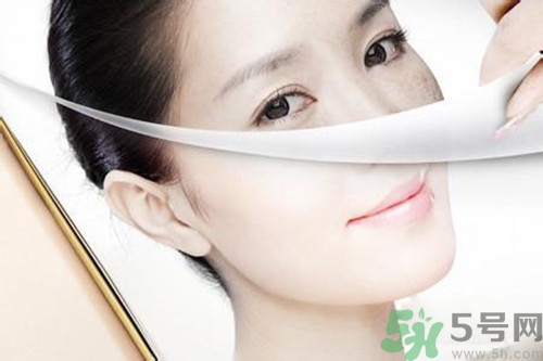 曬斑可以自己消退嗎？曬斑可以用激光去除嗎？