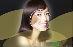 曬斑可以自己消退嗎？曬斑可以用激光去除嗎？