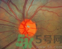 青光眼可以治愈嗎？青光眼怎樣治療？