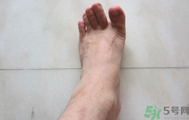 腳拇指外翻遺傳嗎？腳拇指外翻怎么矯正？