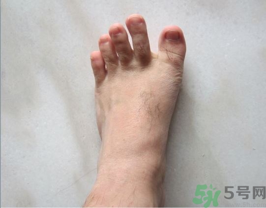 腳拇指外翻遺傳嗎？腳拇指外翻怎么矯正？