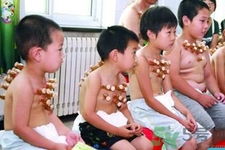 小孩可以拔罐嗎？寶寶能拔火罐嗎？