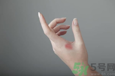 手被燙紅了怎么辦？手被燙了怎么止痛？