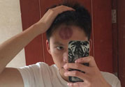 頭痛可以在額頭上拔火罐嗎？額頭上拔火罐有什么好處？