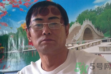 頭痛可以在額頭上拔火罐嗎？額頭上拔火罐有什么好處？