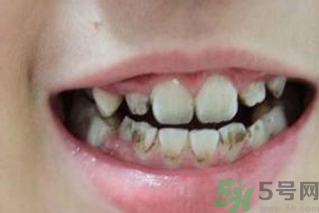 小孩牙齒發(fā)黑怎么回事？小孩牙齒發(fā)黑怎么辦？