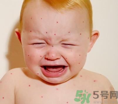 新生兒濕疹怎么引起的？新生兒濕疹如何處理？