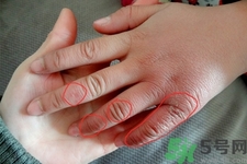 冬天長(zhǎng)凍瘡怎么辦？冬天手上長(zhǎng)凍瘡怎么辦？