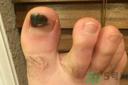 腳趾甲變黑是什么原因？腳趾甲變黑是怎么回事？