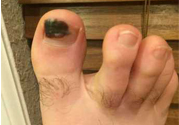 腳趾甲變黑是什么原因？腳趾甲變黑是怎么回事？