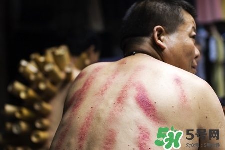背部刮痧后能拔火罐嗎？背部刮痧后拔火罐有什么好處？