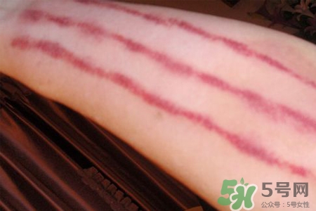 揪痧和刮痧哪個(gè)效果比較好？揪痧和刮痧的區(qū)別？