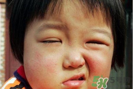 面癱能針灸嗎？針灸能治療面癱嗎？