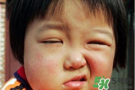 拔牙會(huì)導(dǎo)致面癱嗎?？拔牙為什么會(huì)導(dǎo)致面癱？
