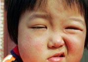 如何預防面癱復發(fā)？導致面癱的四大原因