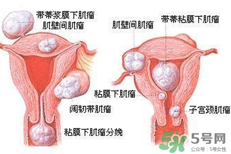 子宮小會影響生育嗎？子宮小會導(dǎo)致不孕嗎？