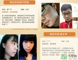 芷軒堂祛痘有效果嗎？芷軒堂祛痘印效果怎么樣？