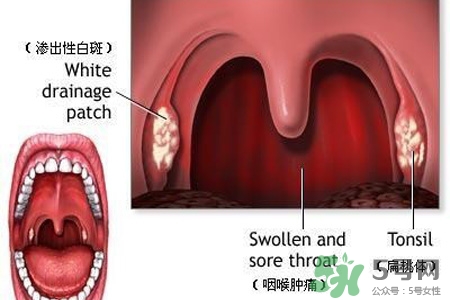 口含大蒜能治療咽炎嗎？巧用大蒜治療咽炎咳嗽