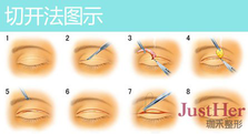 定點雙眼皮怎么做？定點雙眼皮需要拆線嗎？