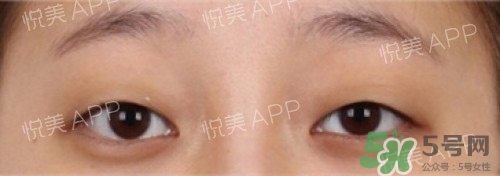 埋線雙眼皮多久恢復自然？埋線雙眼皮多久能恢復