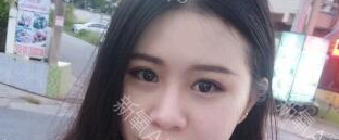 定點(diǎn)雙眼皮能保持多久？定點(diǎn)雙眼皮是永久的嗎？