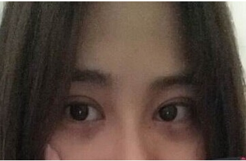 定點雙眼皮怎么做？定點雙眼皮需要拆線嗎？