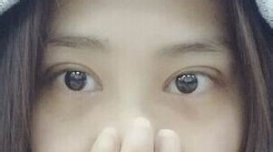 定點雙眼皮怎么做？定點雙眼皮需要拆線嗎？