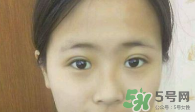 埋線雙眼皮需要拆線嗎？埋線雙眼皮怎么拆線