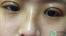 埋線雙眼皮需要拆線嗎？埋線雙眼皮怎么拆線